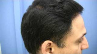Dr Hasson Hair Transplant - 2500 Grafts - 1 Session
