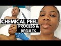 MICRODERM + CHEMICAL PEEL| Full Process + Check Ins & Results!