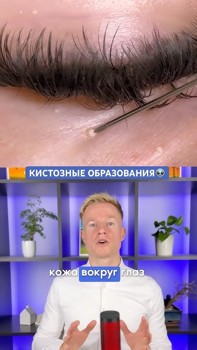 МИЛИУМ👁️ЧТО ЭТО? - кистозные образования на коже #прыщи #лечениекожи # ...