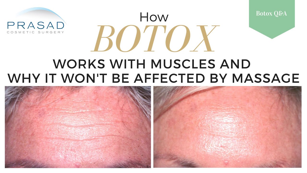 how botox works on muscle receptors to limit movement and why its botox how it works