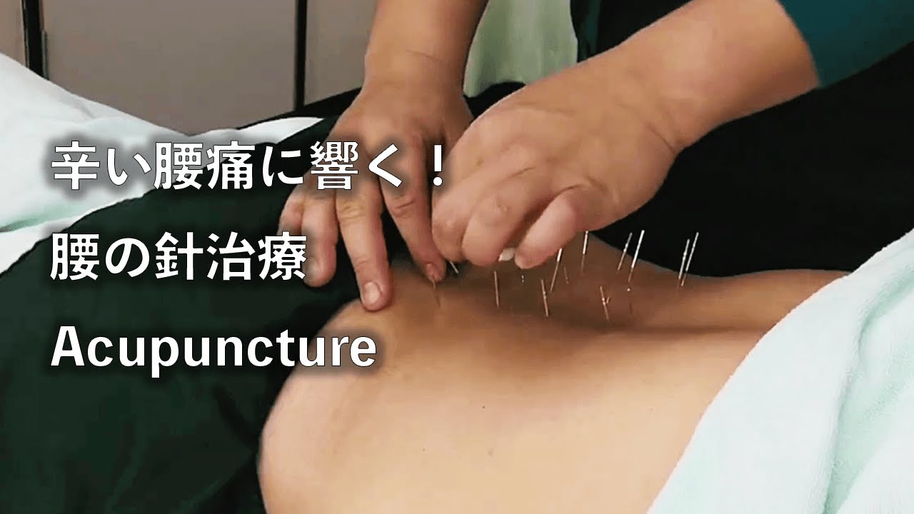 【福岡】辛い腰痛に響く！針治療　Acupuncture
