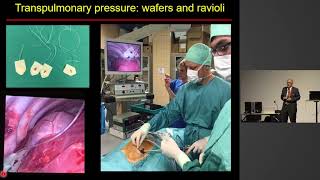 The new PEEP step method for transpulmonary pressure - too good to be true? Paolo Pelosi - SSAI2017
