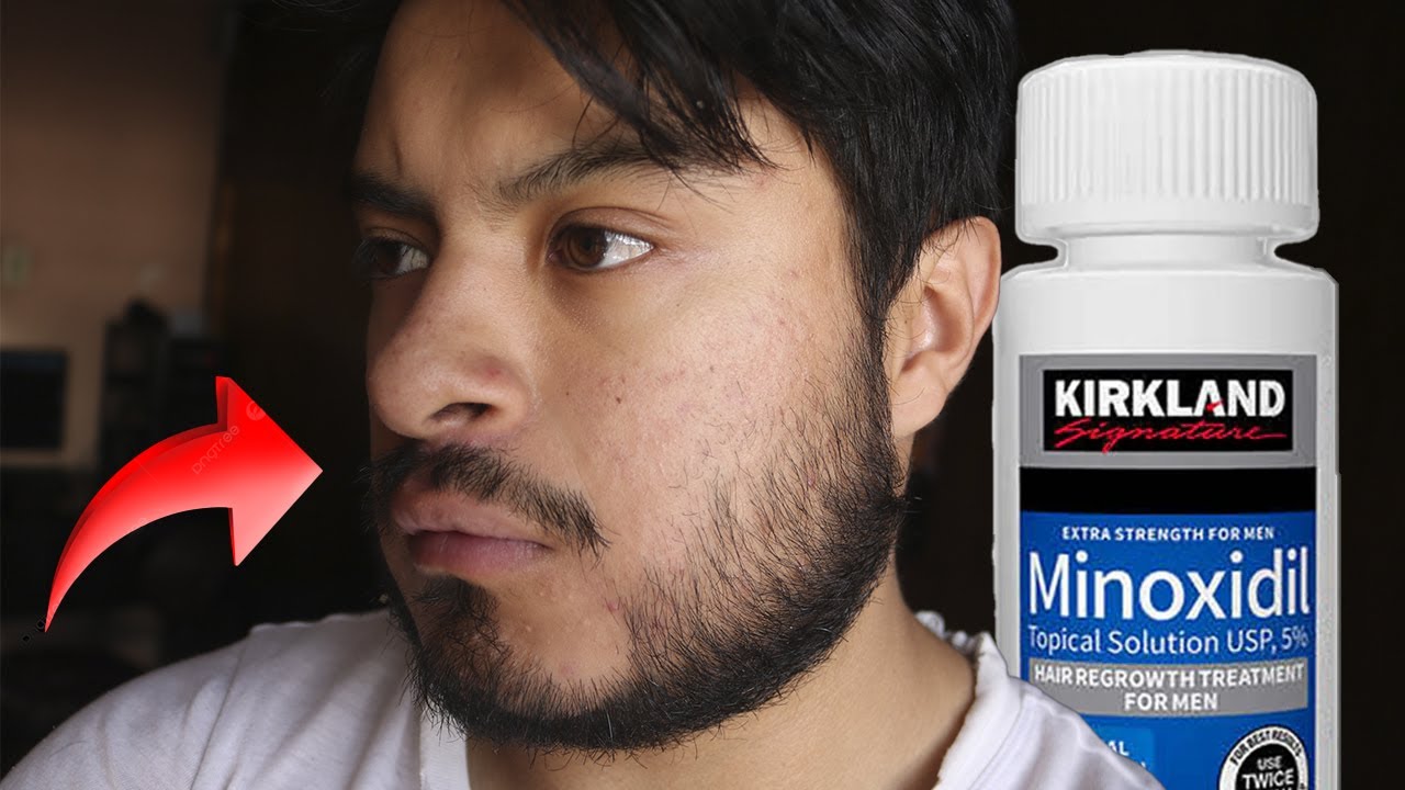 🗿MI SINCERA OPINION DE MI BARBA DE 2 AÑOS DE MINOXIDIL