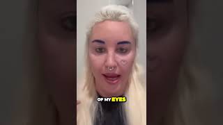 Former Actress Reveals Life-Changing Eyelid Surgery Boosting Confidence And Vision