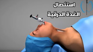 شاهد عملية استئصال الغدة الدرقية_ Thyroidectomy operation 3D medical animation