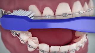 Brushing and Flossing With Braces   Spanish