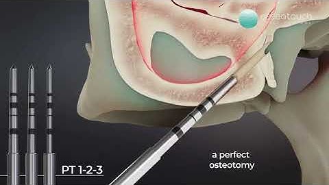 pterygoid implants#dranwar