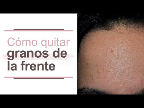 Video: ¿Cómo hacer pequeños granos en la frente?