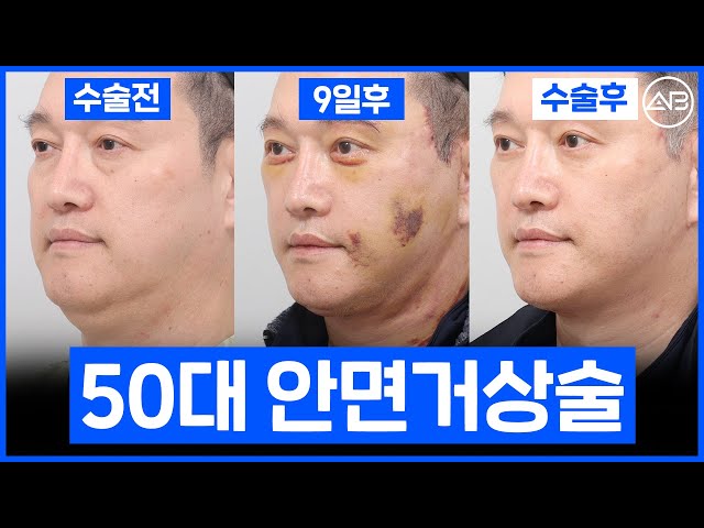 50대 중년의 안면거상술..1달만의 변화! | 성형비포애프터 | 에이비성형외과