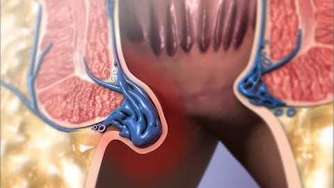 Learn@Visible Body - Hemorrhoids