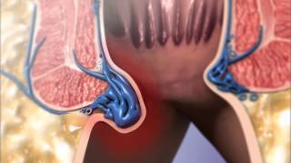 Learn@Visible Body - Hemorrhoids
