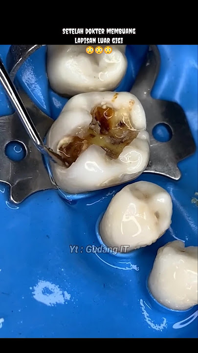 INILAH ALASAN KENAPA HARUS SIKAT GIGI