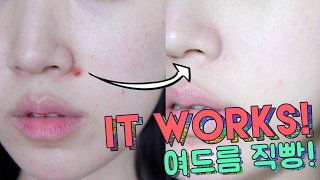 S.O.S Skincare Routine for Acne // How To Calm Down Acne FAST & IT WORKS! 🌴 Liah Yoo