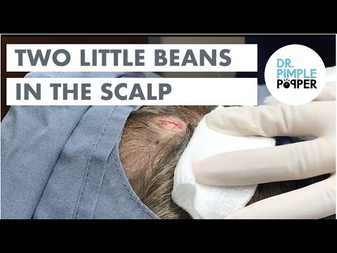 Video: What Is Baldhead In Beans: Treating Baldhead Disease on Bean Plants