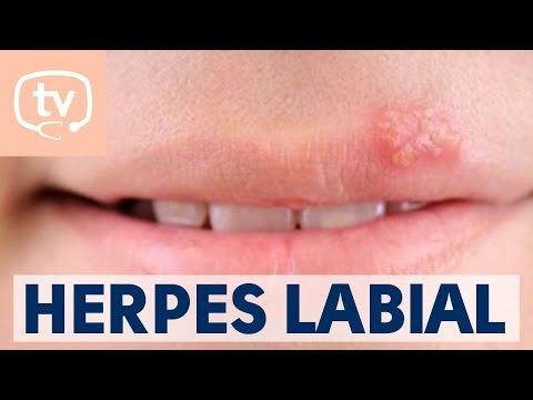 El herpes labial: qué es, causas y tratamiento