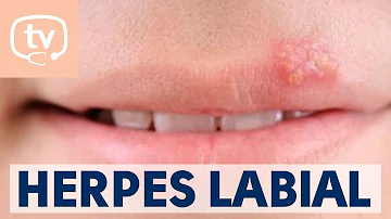 ¿Qué empeora el herpes labial?