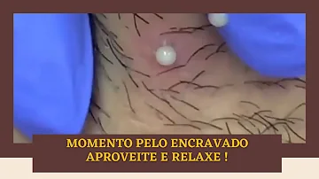 Como tirar pelo encravado no olho?