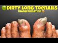 DIRTY LONG TOENAILS TRANSFORMATION