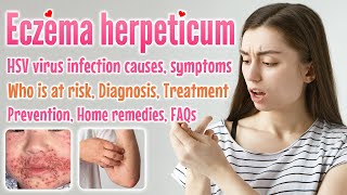 Eczema Herpeticum Overview, Causes, Symptoms, Diagnosis, Treatment,  Home Remedies, prevention, FAQS