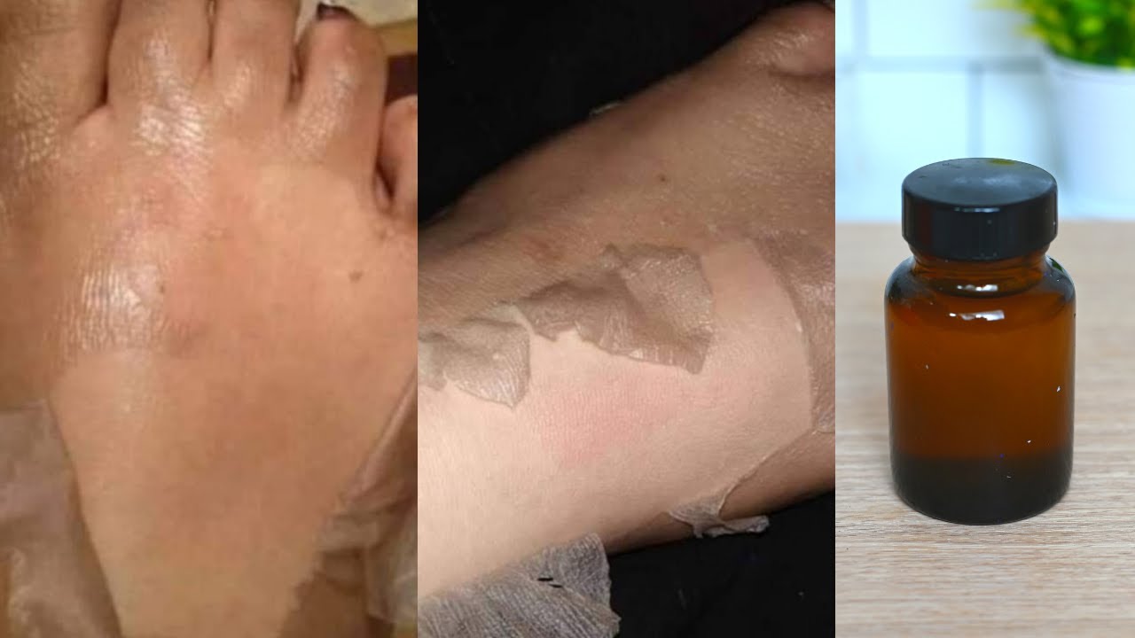 كيفية عمل محلول تقشير احماض الفواكه| لازالة تصبغات الركب والاكواع