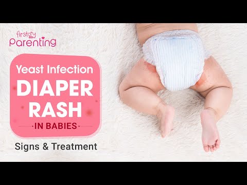Yeast Infection Diaper Rash in Babies - Causes and Remedies