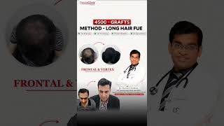 Long Hair Transplant के 6 Months बाद कैसा रहा Result? | Real Patient Experience | Derma clinix