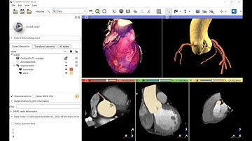 Coronary vessel segmentation on cardiac CT images