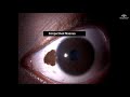 Slit Lamp examination techniques for beginners