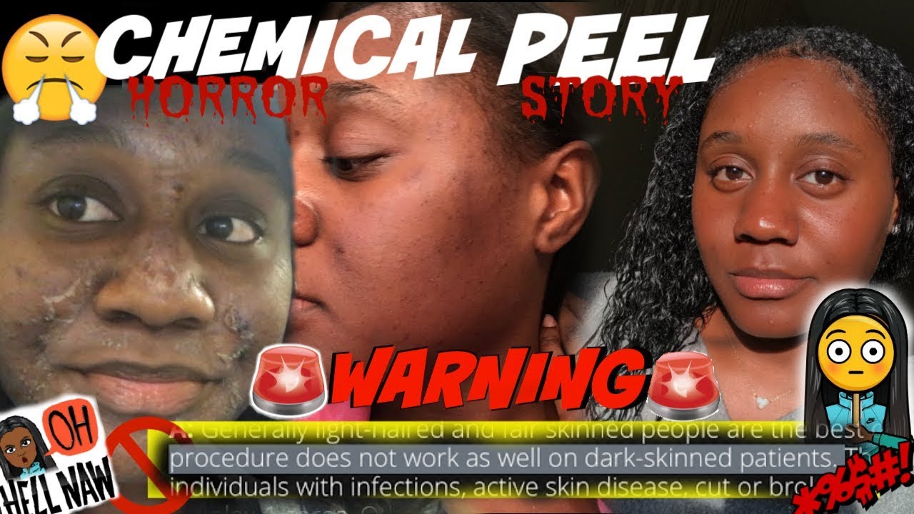 CHEMICAL PEEL EXPERIENCE | BLACK GIRL FRIENDLY?!