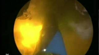 Celebrity GreenLight Laser MoXy - The Prostate Clinic Net Worth