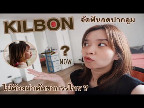 รีวิวเครื่องมือจัดฟัน KILBON ลดปากอูมโดยไม่ผ่าตัดขากรรไกร | MY BRACE DIARY EP.1