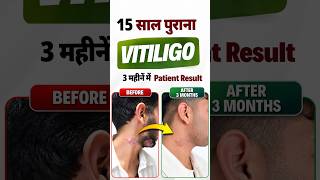 15 साल पुराना Vitiligo, 3 महीने में 95% Improvement | Melanocyte Transplant Patient Result