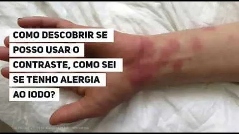 O que é alergia alimentar e quais são os três fatores que estão relacionados ao seu desenvolvimento?