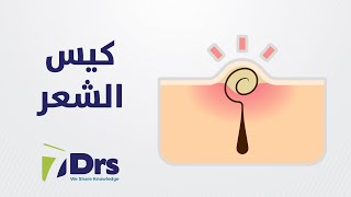 ماهو كيس الشعر وكيف يتم علاجه - الأطباء السبعة - الموسم 9