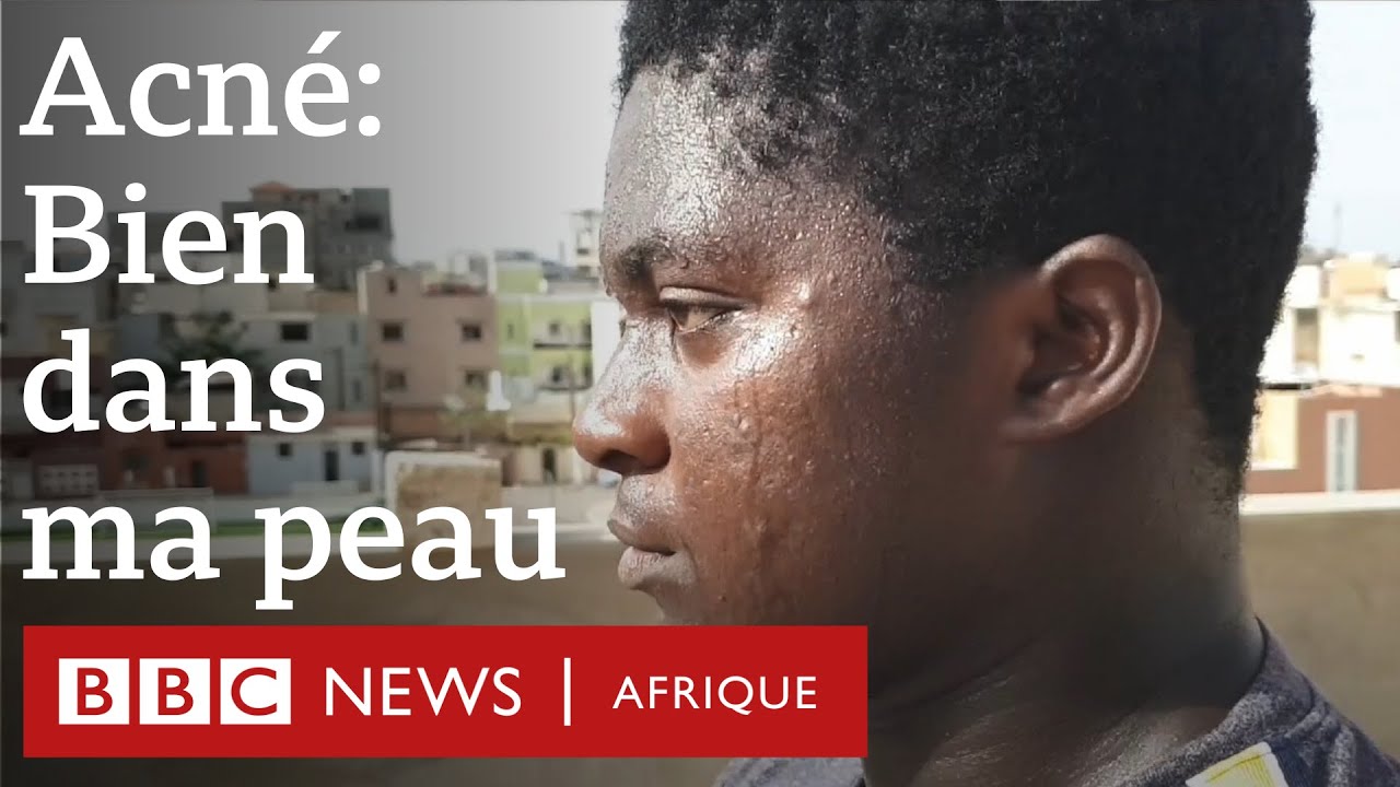 L'acné ne m'a pas volé ma joie de vivre - problèmes de peau