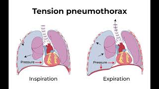 Needle Decompression