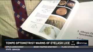 Warnings About Eyelash Lice