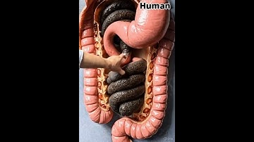 How Constipation Blocks Your Colon – 3D Look Inside #shorts #anatomy