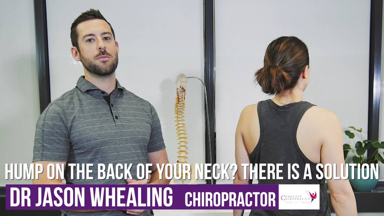 Hump On The Back Of Your Neck Chiropractic Help YouTube