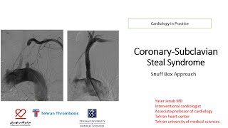 Subclavian coronary steal syndrome