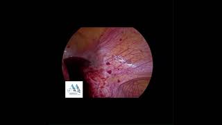 Laparoscopic exploration, pelvic abscess drainage and appendectomy