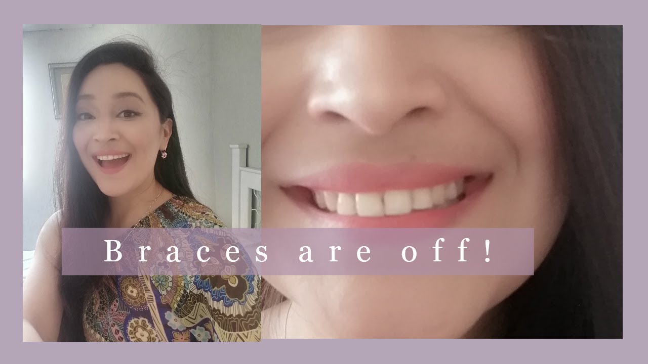 Braces are off Braces appointment, retainers, experience YouTube