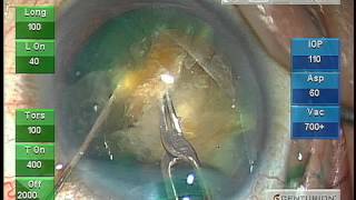 MICS Suite by ASICO with Alcon Centurion™ Grade V Cataract by Dr. Akahoshi screenshot 5