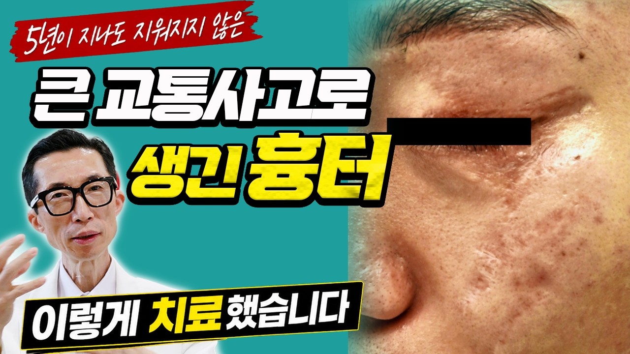 절망했던 얼굴 흉터, 인생이 바뀐 실제 치료 과정 전격 공개!???? [핀홀셀 치료 실제 후기]
