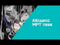 Болезнь Крона ? (ждём ответа от хирургов), абсцесс МРТ (ПОДРОБНЫЙ РАЗБОР).