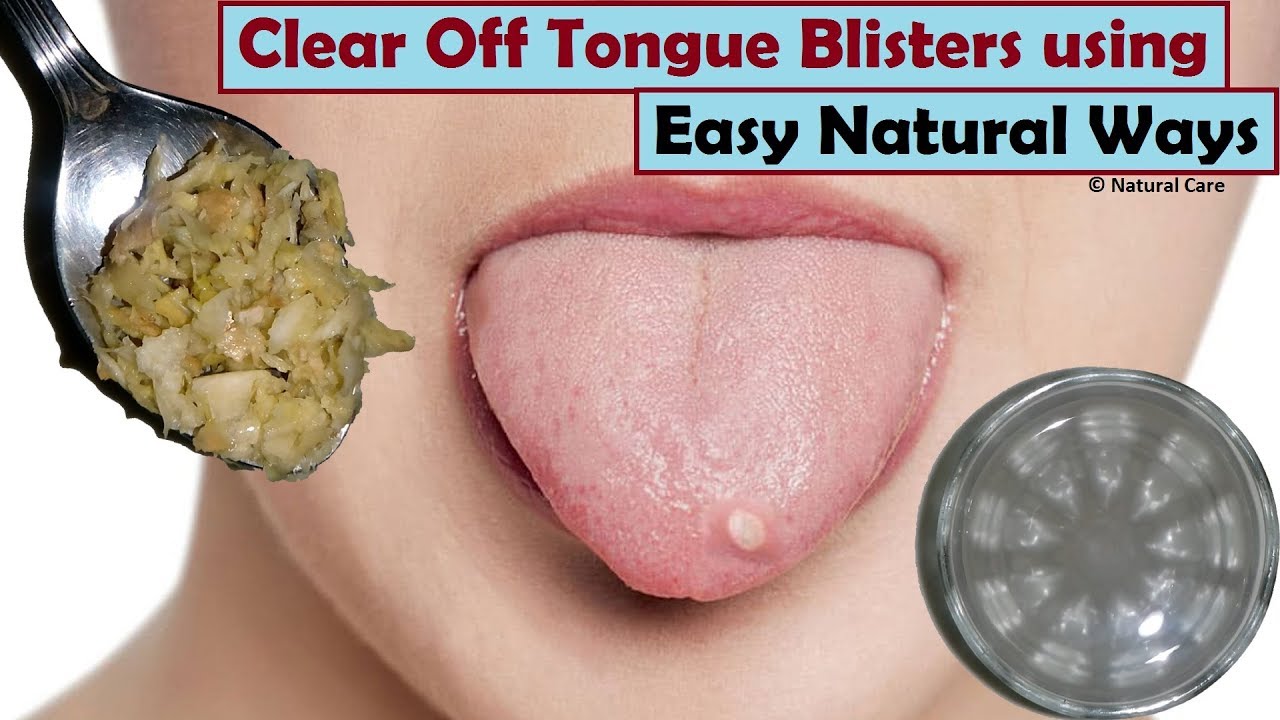 workout exercise ball Clear Off Tongue Blisters using Easy Natural Ways