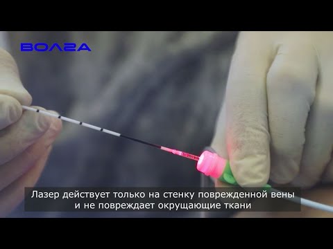 Лазерные технологии в лечении варикоза (Центр Флебологии в Нижнем Новгороде)