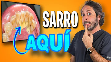 ¿Qué ocurre cuando el sarro se desprende de los dientes?