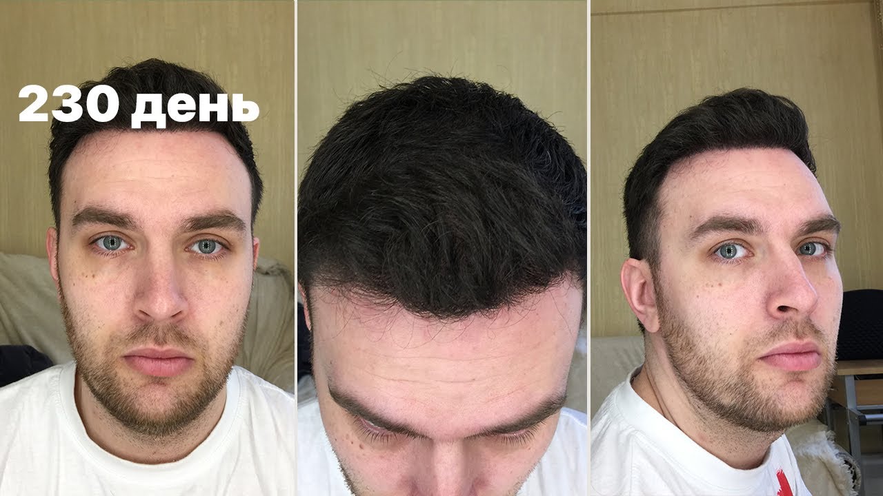 Пересадка волос в стамбуле. Пересадка волос в Турции. Трансплантация волос в Турции. Стамбул пересадка волос до и после.