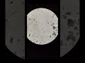 Urine Microscopy: Trichomonas Vaginalis,, Yellow or greenish discharge in urine,, প্রস্রাব ইনফেকশন,